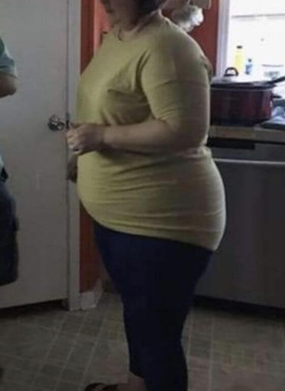 An obese woman in green sweater, side view before PCOS Weight Loss treatment